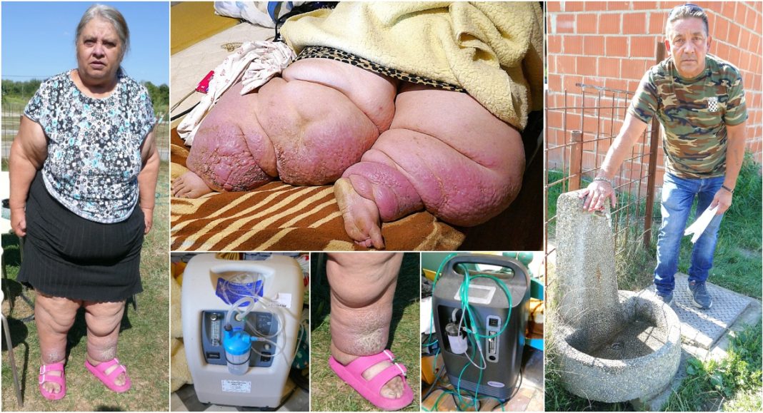 Svetlana (39) teško je bolesna, pada u komu, vatrogasci su je morali dizati jer ima više od 240 kilograma! Kako da preživi i ona i majka!? Svetlana (39) teško je bolesna, pada u komu, vatrogasci su je morali dizati jer ima više od 240 kilograma! Kako da preživi i ona i majka!?